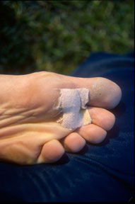 Blisters on a Whitehill Foot